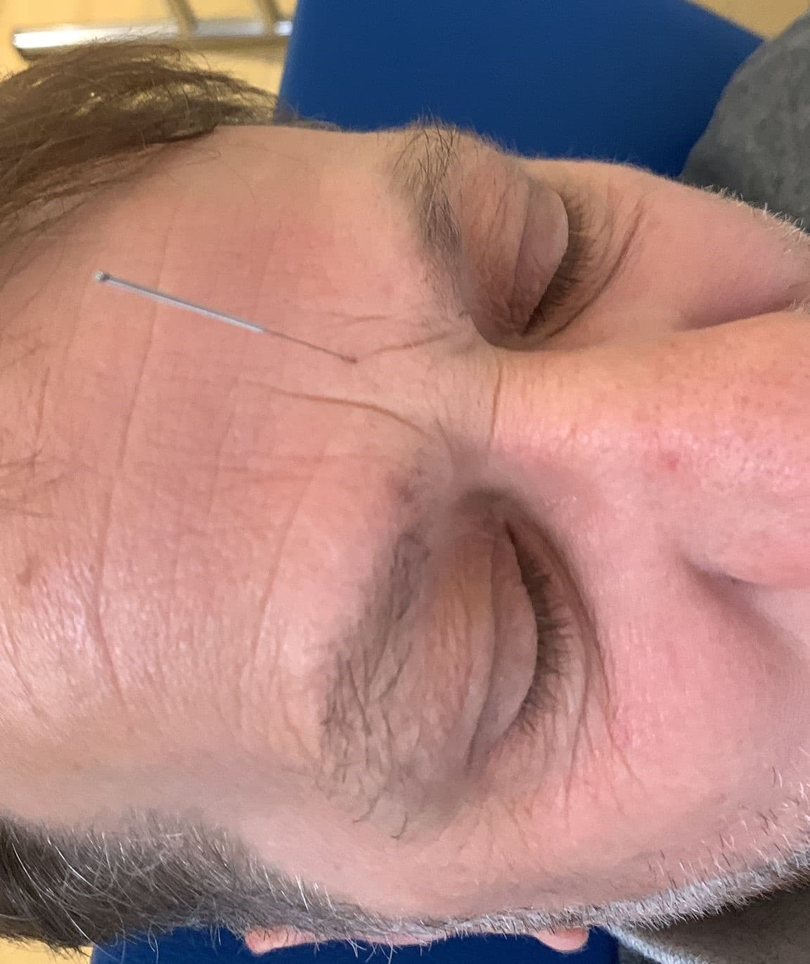 Neuralterapia — trattamento antalgico
